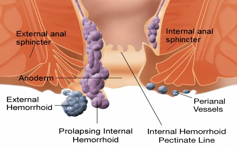 Causes of Hemorrhoids