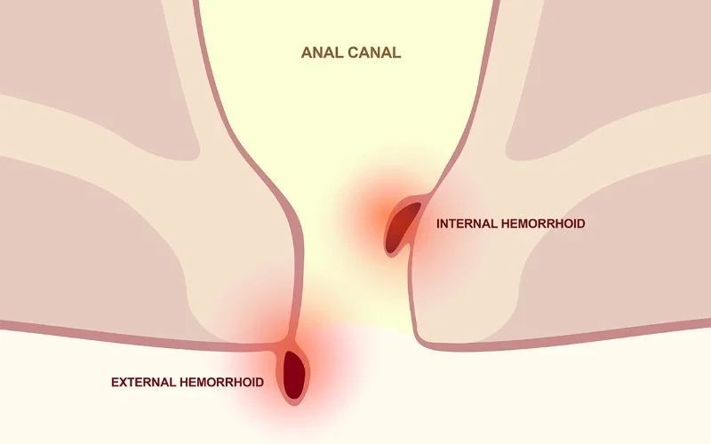 What are Hemorrhoids